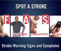 stroke